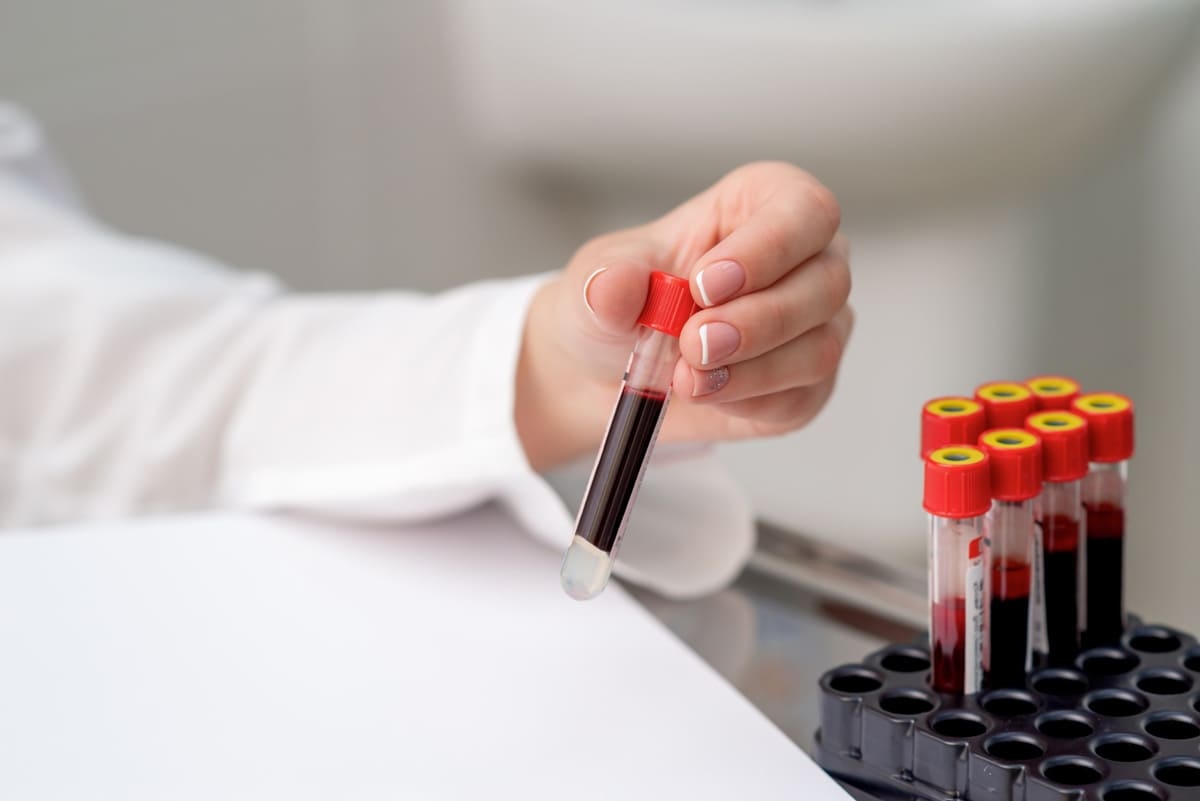 laboratuvar testi için alınan kan örneği